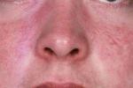 Покраснение и шелушение кожи вокруг носа: причины, лечение