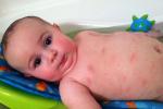 Дерматит у грудных детей: внешний вид на фото, причины возникновения заболевания у новорожденных, симптомы и лечение