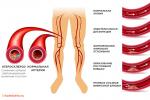 Ateroskleroza perifernih arterija - opis, uzroci, simptomi (znakovi), dijagnoza, liječenje Generalizirana ateroskleroza ICD 10
