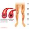 Атеросклероз периферических артерий - описание, причины, симптомы (признаки), диагностика, лечение Генерализованный атеросклероз мкб 10