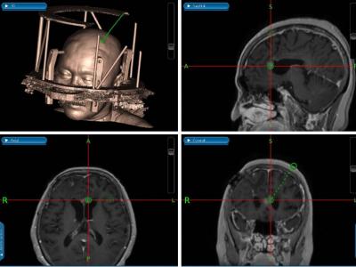 Лимфома головного мозга: причины, симптомы, лечение и прогноз